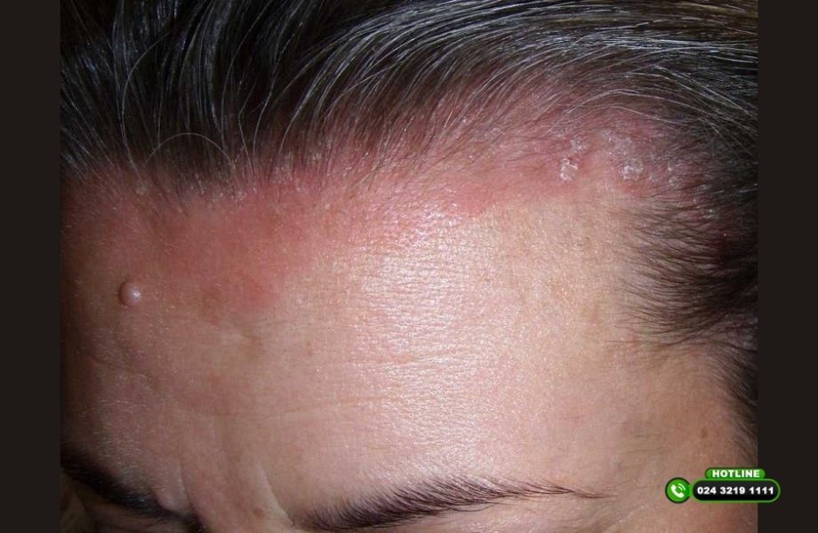 Nguyên nhân bị gàu và rụng tóc: Không chỉ do vệ sinh kém như nhiều người vẫn nghĩ