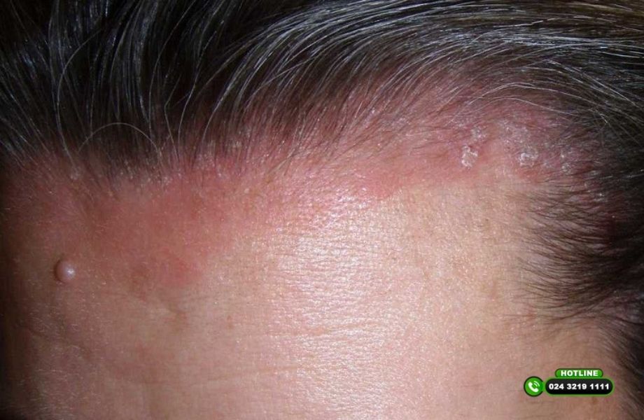 Minoxidil là gì? Lưu ý khi dùng Minoxidil trị rụng tóc, hói đầu