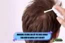 Minoxidil có dùng sau cấy tóc được không? Thời điểm và những lưu ý cần biết