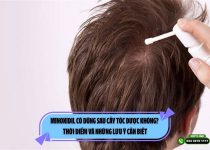 Minoxidil có dùng sau cấy tóc được không? Thời điểm và những lưu ý cần biết