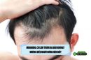 Minoxidil có làm thâm da đầu không? Những điều người dùng nên biết
