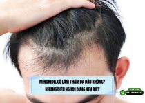 Minoxidil có làm thâm da đầu không? Những điều người dùng nên biết