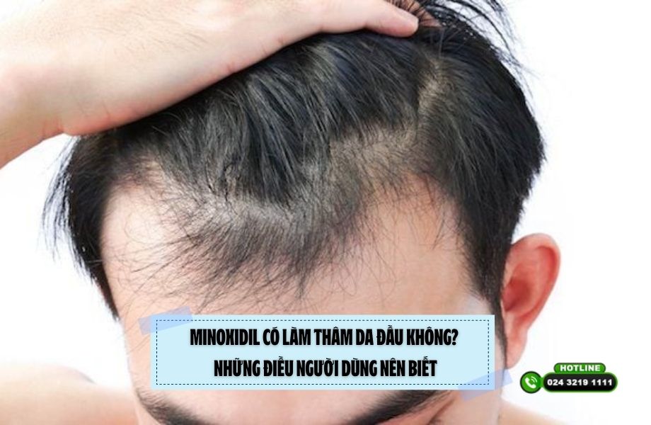 Minoxidil có làm thâm da đầu không? Những điều người dùng nên biết