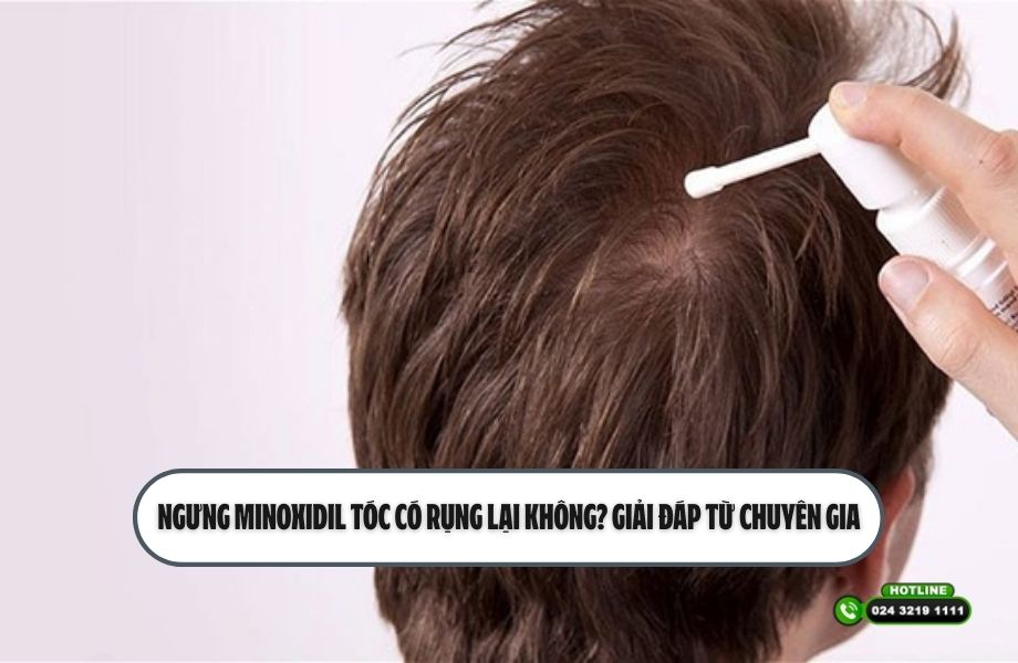 Ngưng Minoxidil tóc có rụng lại không? Giải đáp từ chuyên gia
