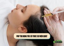 PRP trị rụng tóc có thực sự hiệu quả? 