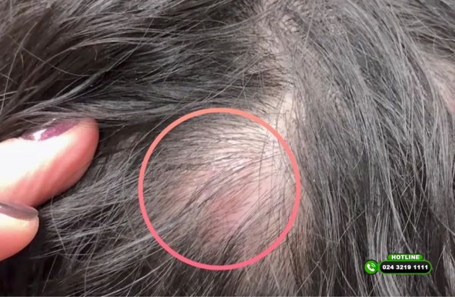 Minoxidil có làm thâm da đầu không? Những điều người dùng nên biết