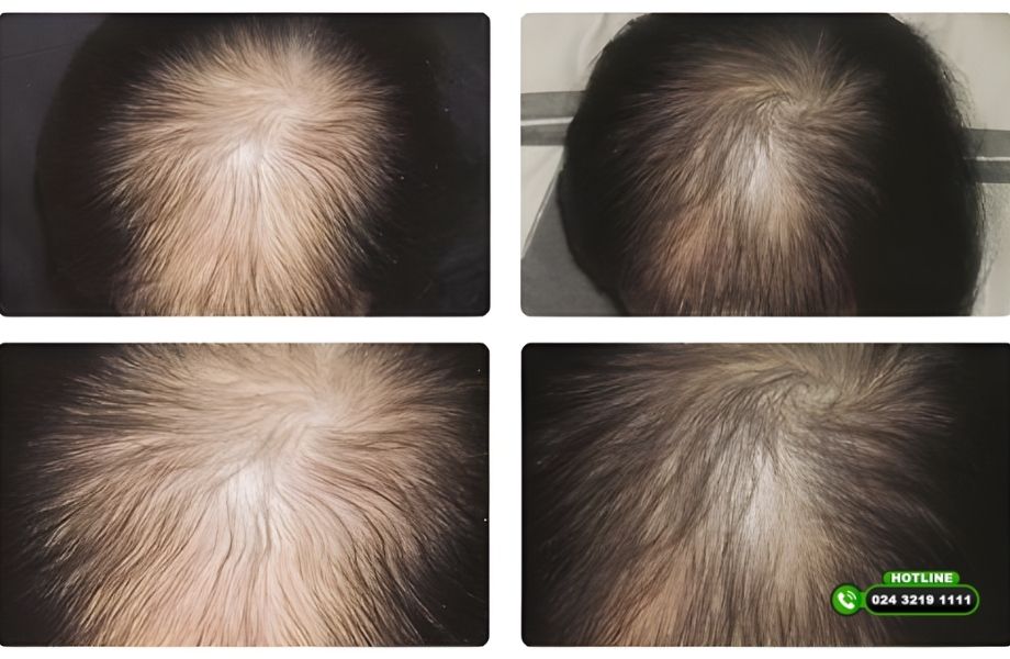 [Giải đáp]: Truyền hóa chất có gây rụng tóc không? 