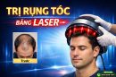 Sự thật về trị rụng tóc bằng laser: Ai nên làm, ai không?