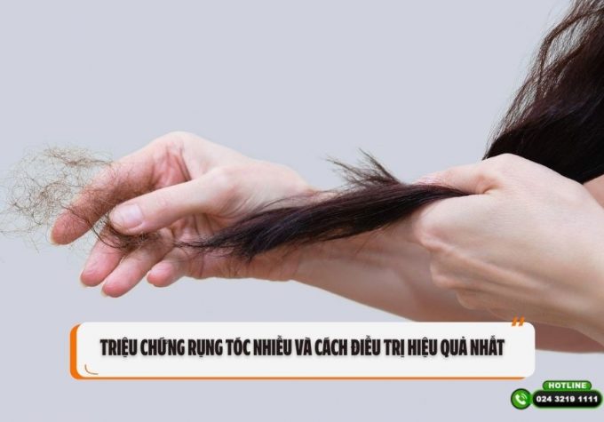 Triệu chứng rụng tóc nhiều và cách điều trị hiệu quả nhất