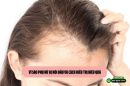 Vì sao phụ nữ bị hói đầu và cách điều trị hiệu quả 