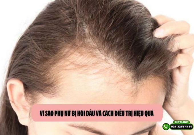 Vì sao phụ nữ bị hói đầu và cách điều trị hiệu quả 