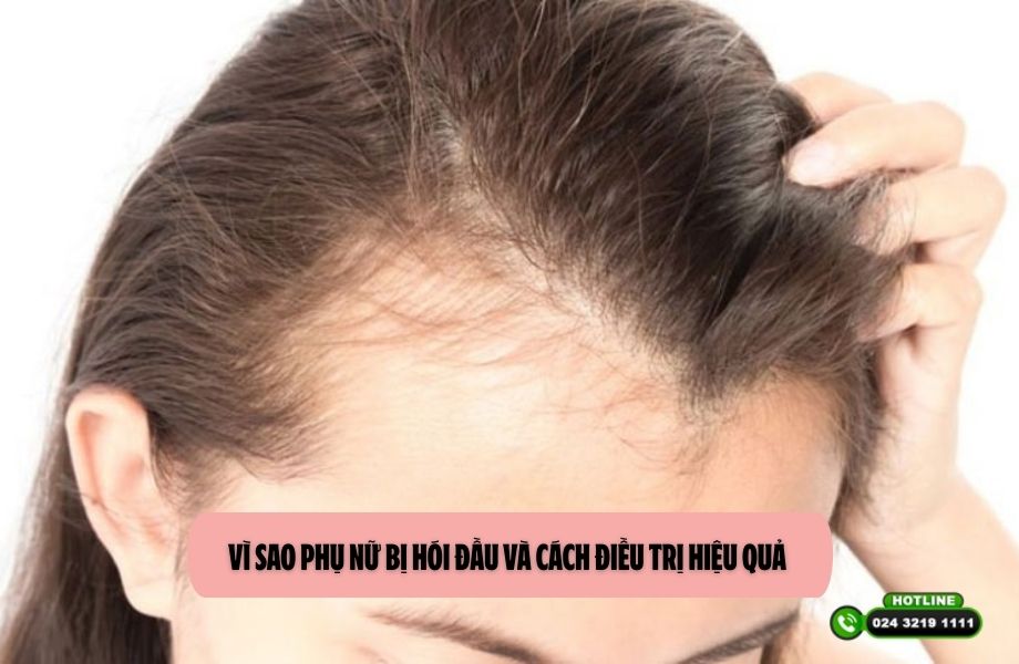 Vì sao phụ nữ bị hói đầu và cách điều trị hiệu quả 