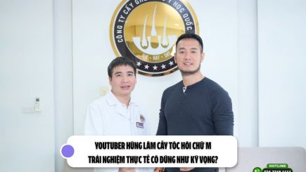 Youtuber Hùng Lâm cấy tóc hói chữ M: Trải nghiệm thực tế có đúng như kỳ vọng?