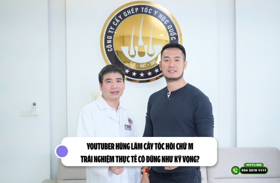Youtuber Hùng Lâm cấy tóc hói chữ M: Trải nghiệm thực tế có đúng như kỳ vọng?