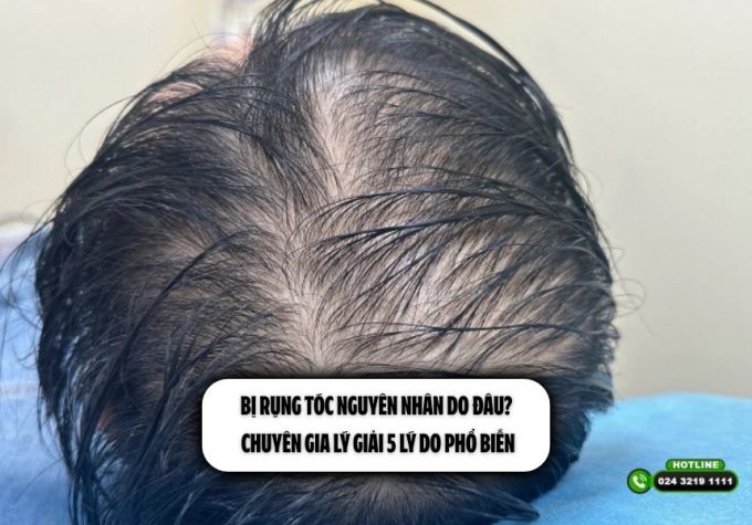 Bị rụng tóc nguyên nhân do đâu? Chuyên gia lý giải 5 lý do phổ biến
