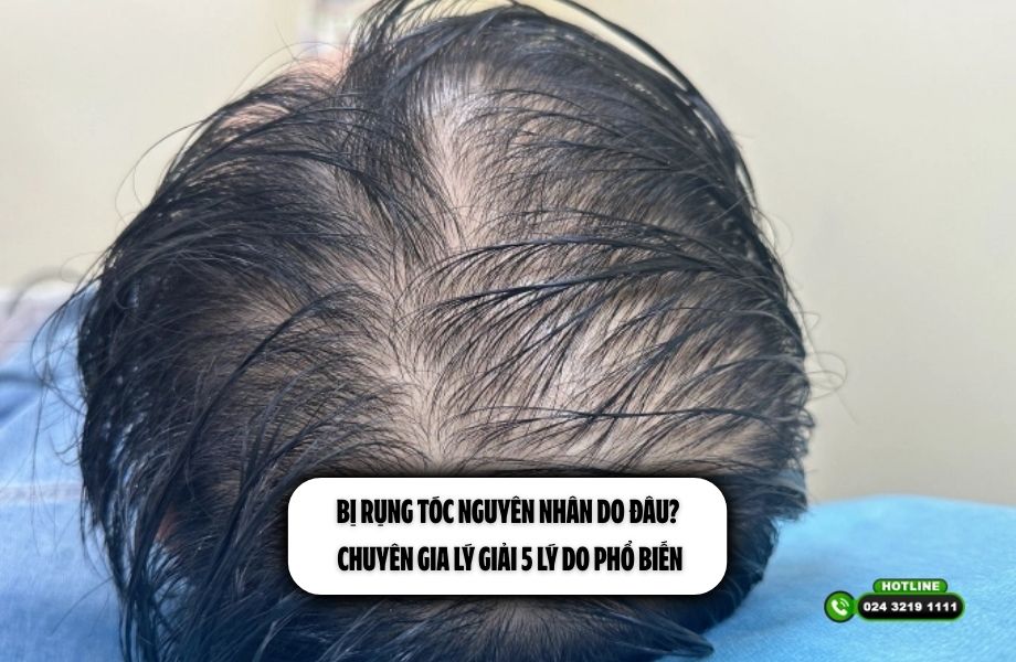 Bị rụng tóc nguyên nhân do đâu? Chuyên gia lý giải 5 lý do phổ biến