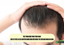 Tóc thưa dần theo thời gian - Đây có thể là các nguyên nhân dẫn đến rụng tóc mà bạn đang bỏ qua