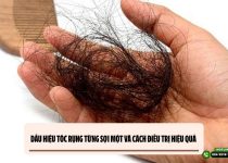 Dấu hiệu tóc rụng từng sợi một và cách điều trị hiệu quả 