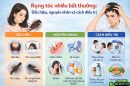 Rụng tóc nhiều bất thường: Dấu hiệu, nguyên nhân và cách điều trị