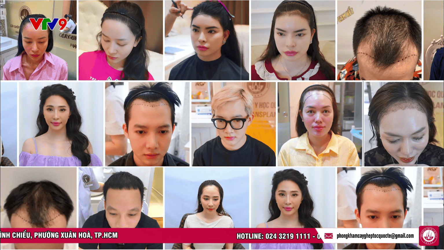 cấy tóc trị hói