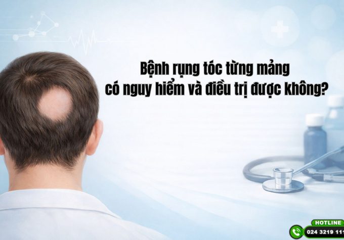 Chuyên gia giải đáp: Bệnh rụng tóc từng mảng có nguy hiểm và điều trị được không?