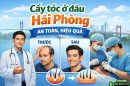 Cấy tóc ở đâu Hải Phòng an toàn, hiệu quả? Góc nhìn từ khách hàng thực tế