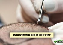 Cấy tóc tự thân tại Hải Phòng nên chọn cơ sở nào? 
