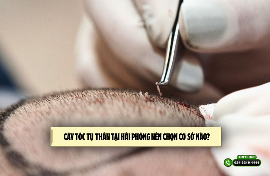 Cấy tóc tự thân tại Hải Phòng nên chọn cơ sở nào? 