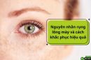 Nguyên nhân rụng lông mày và cách khắc phục hiệu quả