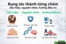 Rụng tóc thành từng chỏm: Dấu hiệu, nguyên nhân, hướng điều trị