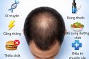 Rụng tóc trên đỉnh đầu: Giải pháp khắc phục an toàn và hiệu quả