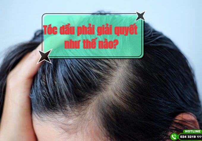 [Chia sẻ bí quyết] : Tóc dầu phải giải quyết như thế nào?