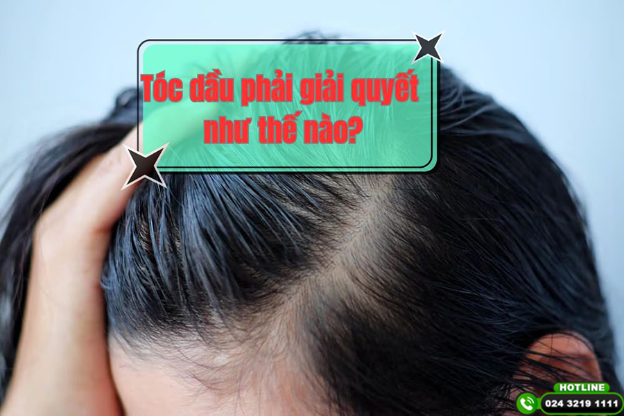 [Chia sẻ bí quyết] : Tóc dầu phải giải quyết như thế nào?