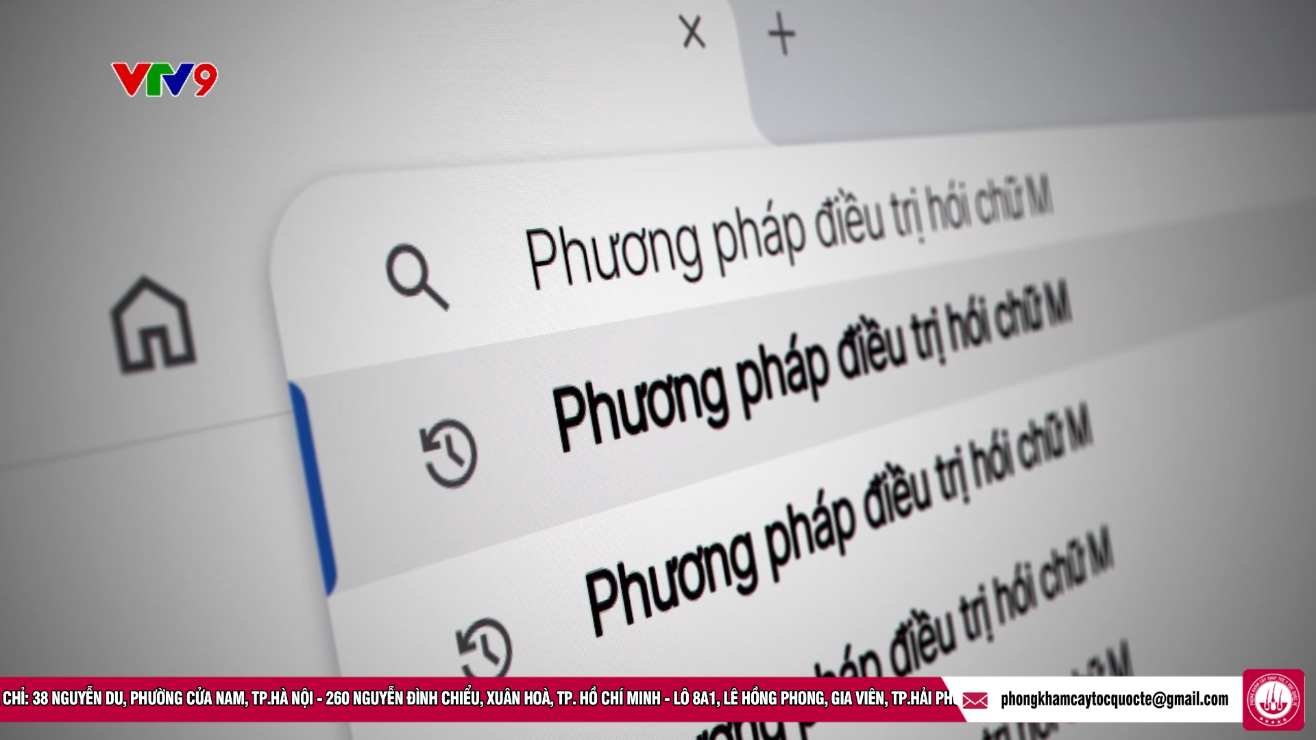 cấy tóc trị hói