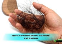 Chuyên gia chỉ rõ biểu hiện tóc rụng bệnh lý và tóc rụng sinh lý để điều trị đúng hướng