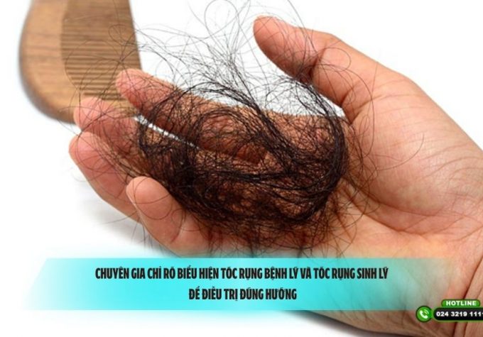Chuyên gia chỉ rõ biểu hiện tóc rụng bệnh lý và tóc rụng sinh lý để điều trị đúng hướng