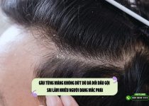 Gàu từng mảng không dứt dù đã đổi dầu gội - Sai lầm nhiều người đang mắc phải