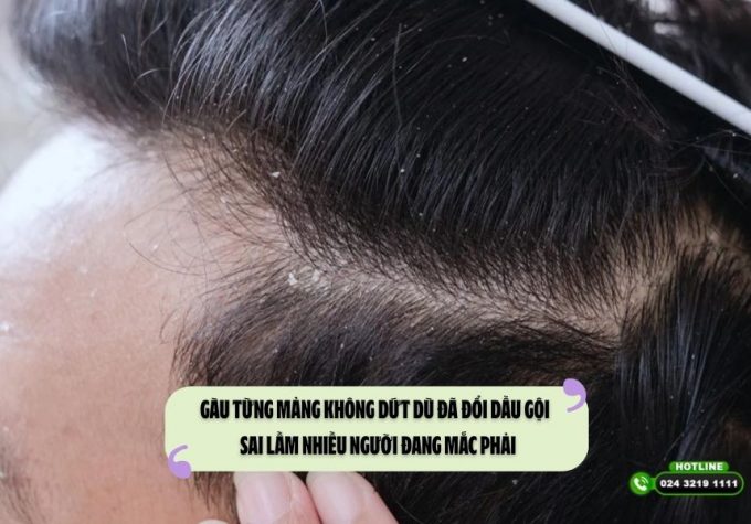 Gàu từng mảng không dứt dù đã đổi dầu gội – Sai lầm nhiều người đang mắc phải