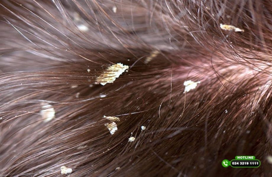 Gàu từng mảng không dứt dù đã đổi dầu gội - Sai lầm nhiều người đang mắc phải