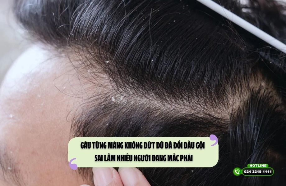 Gàu từng mảng không dứt dù đã đổi dầu gội – Sai lầm nhiều người đang mắc phải