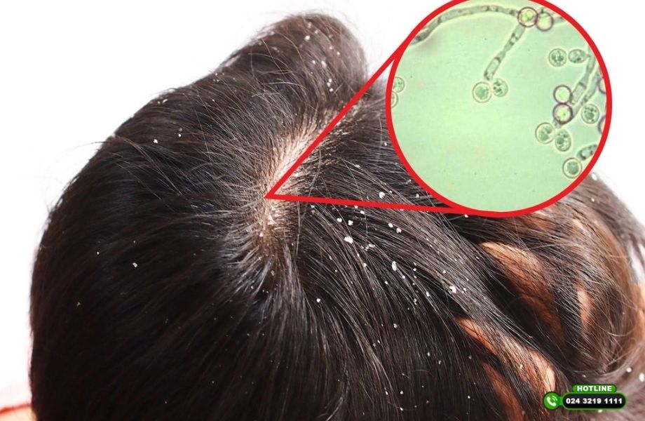 Đầu ngứa do đâu? Nguyên nhân thường gặp và cách khắc phục