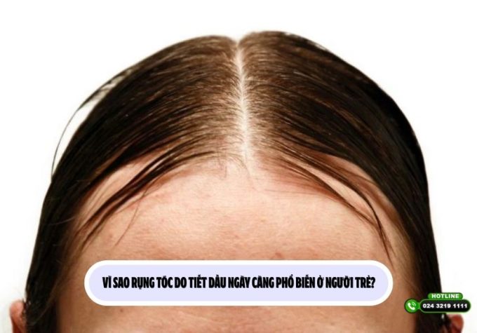 Vì sao rụng tóc do tiết dầu ngày càng phổ biến ở người trẻ?