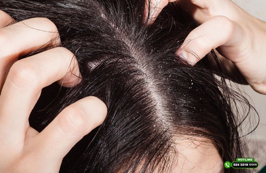 Đầu ngứa do đâu? Nguyên nhân thường gặp và cách khắc phục