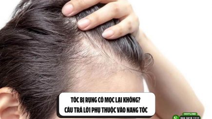Tóc bị rụng có mọc lại không? Câu trả lời phụ thuộc vào nang tóc