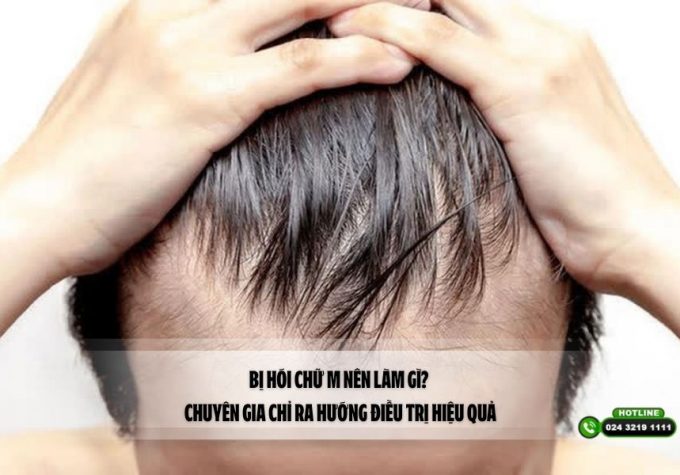 Bị hói chữ M nên làm gì? Chuyên gia chỉ ra hướng điều trị hiệu quả