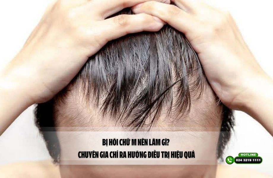 Bị hói chữ M nên làm gì? Chuyên gia chỉ ra hướng điều trị hiệu quả