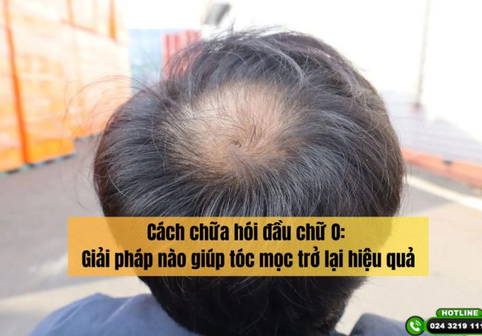 Cách chữa hói đầu chữ O: Giải pháp nào giúp tóc mọc trở lại hiệu quả