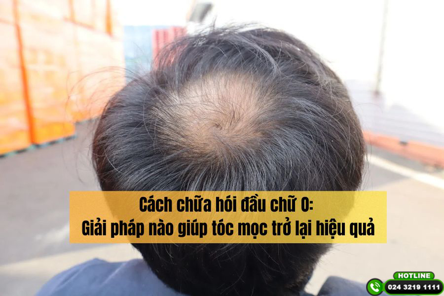 Cách chữa hói đầu chữ O: Giải pháp nào giúp tóc mọc trở lại hiệu quả