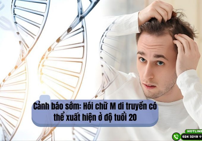 Cảnh báo sớm: Hói chữ M di truyền có thể xuất hiện ở độ tuổi 20