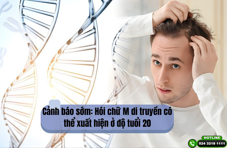 Cảnh báo sớm: Hói chữ M di truyền có thể xuất hiện ở độ tuổi 20